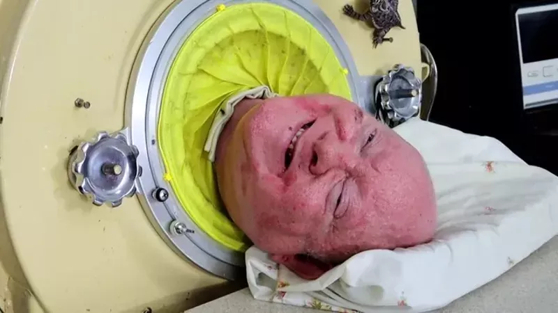 Image: Lawyer and Dallas native Paul Alexander in an iron lung.
